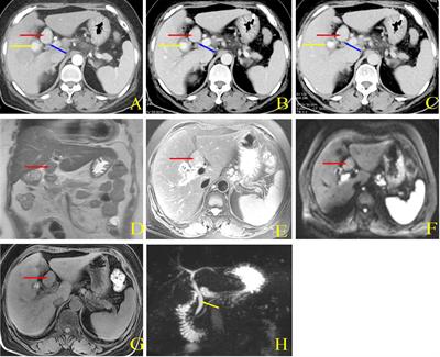 Ectopic thyroid in the hepatoduodenal ligament: a case report and literature review